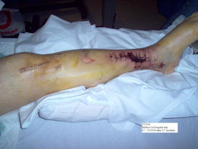 Leg Injuries from a Motorcycle Accident 