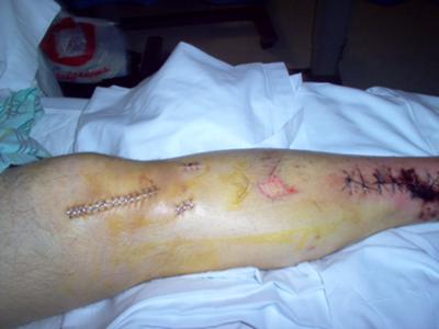 Leg Injuries from Motorcycle Accident