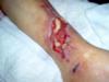 Leg Injuries from Motorcycle Accident 